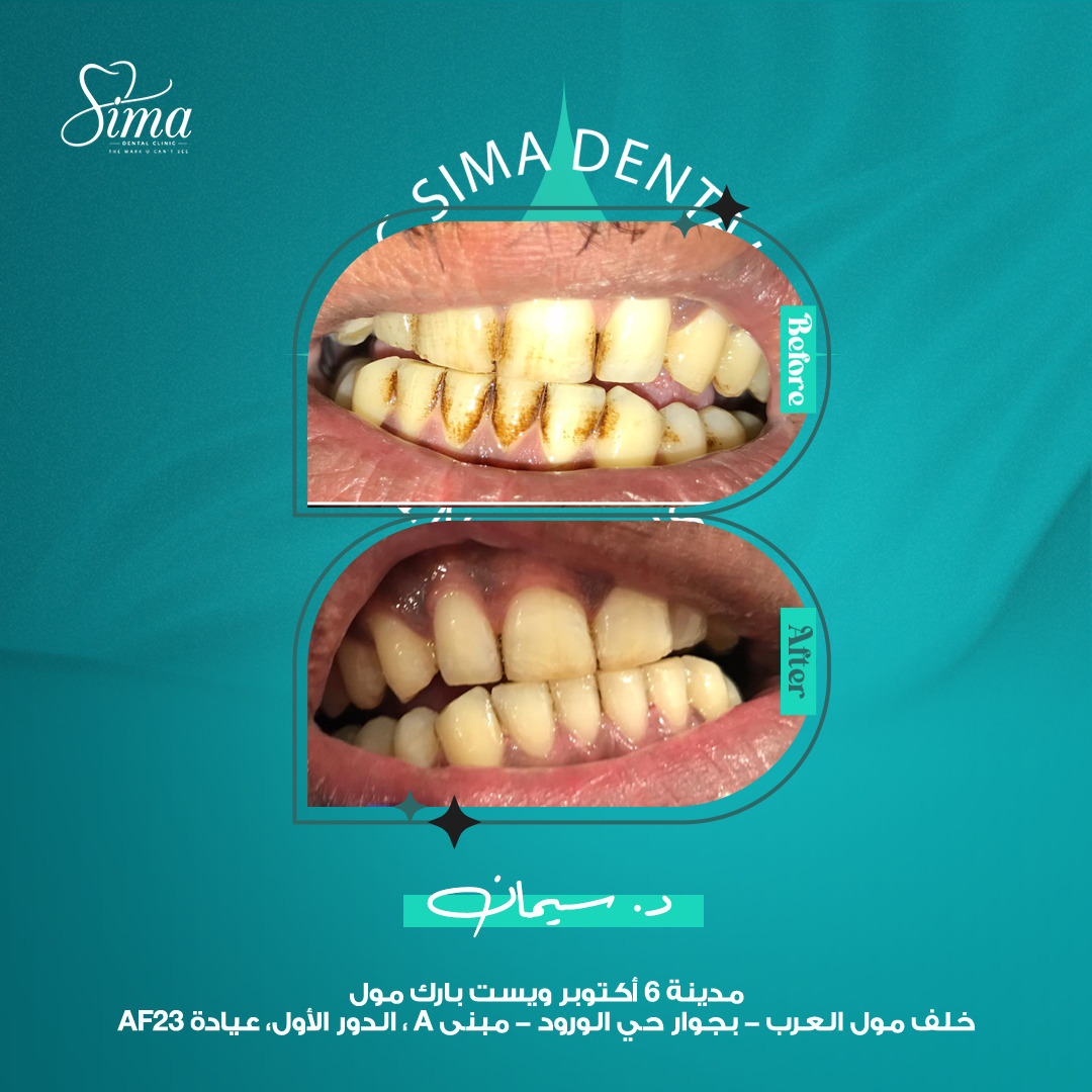 قبل وبعد — دكتورة سيمان