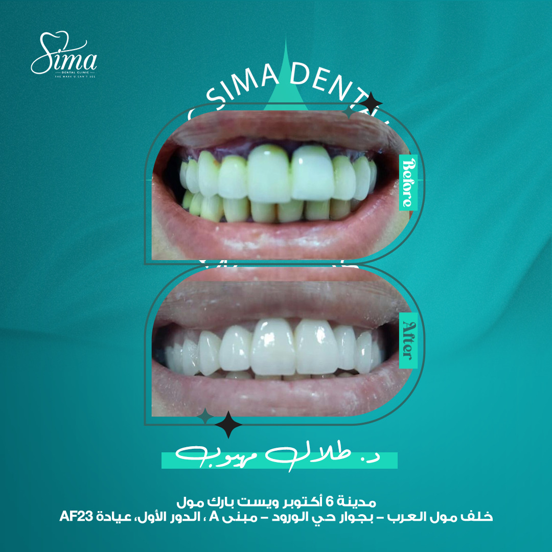 قبل وبعد — دكتور طلال مهيوب